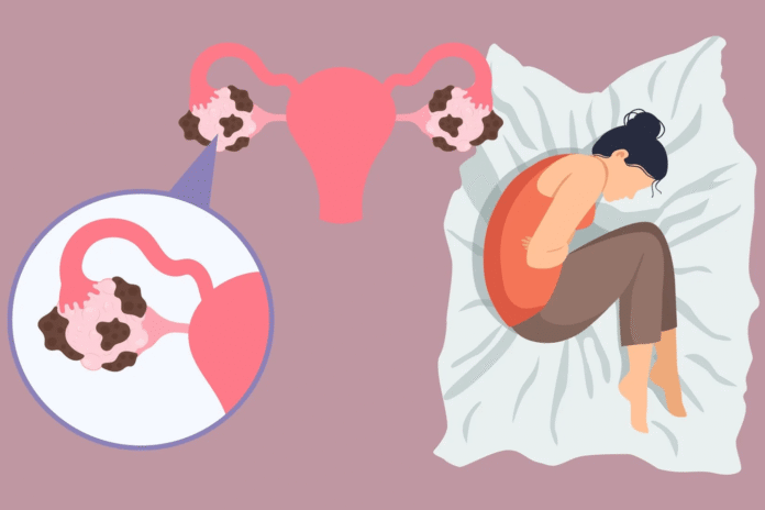 Η ενδομητρίωση επηρεάζει τη σεξουαλική ζωή και τη γονιμότητα. Μάθε πώς επηρεάζει τα ζευγάρια και τι προτείνει ο Δρ. Ηλίας Μεταξάς.