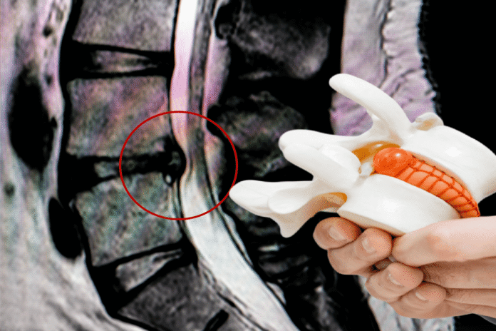 Ανακούφιση από πόνο στη μέση με τη μέθοδο μηχανικής αποσυμπίεσης δίσκου. Μια ασφαλής και μη επεμβατική λύση για οσφυαλγία και δισκοκήλη.