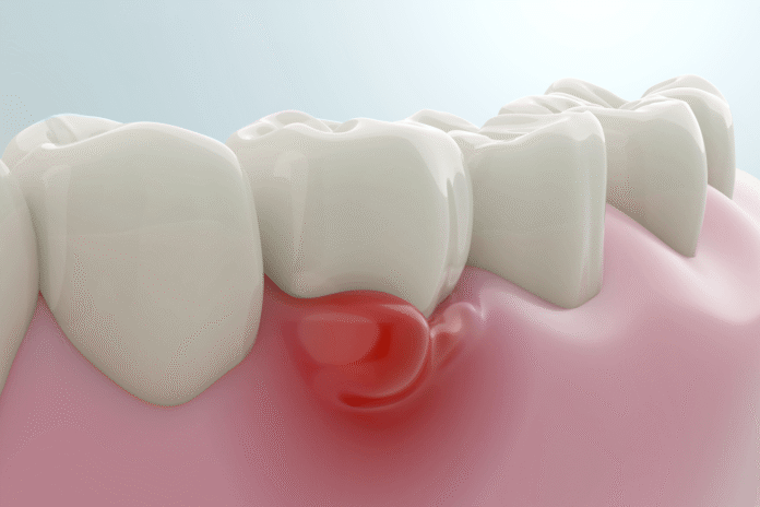 Η ουλίτιδα είναι κάτι παραπάνω από φλεγμονή των ούλων. Μάθε πώς σχετίζεται με τη στοματική και γενική υγεία και πώς μπορεί να αντιμετωπιστεί.