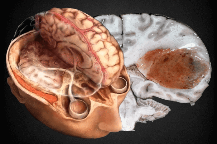 Σύγχρονες μέθοδοι στη νευροχειρουργική για το πολύμορφο γλοιοβλάστωμα με σεβασμό στη λειτουργικότητα και την ανθρώπινη αξιοπρέπεια.