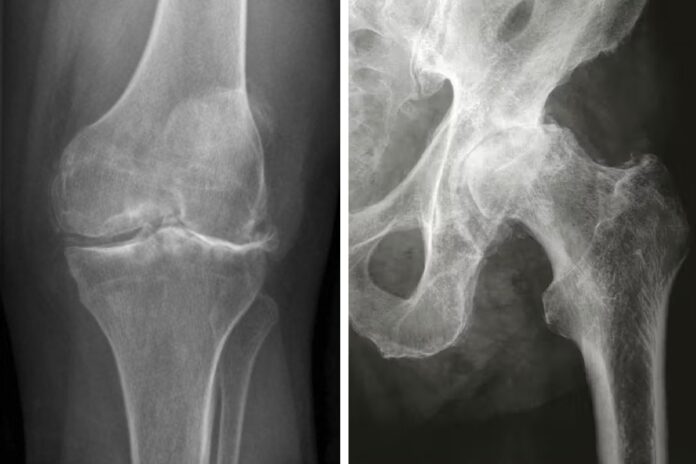 Μάθετε τα αίτια, συμπτώματα και τις σύγχρονες θεραπείες για την οστεοαρθρίτιδα ισχίου και γόνατος. Τι να προσέξετε.