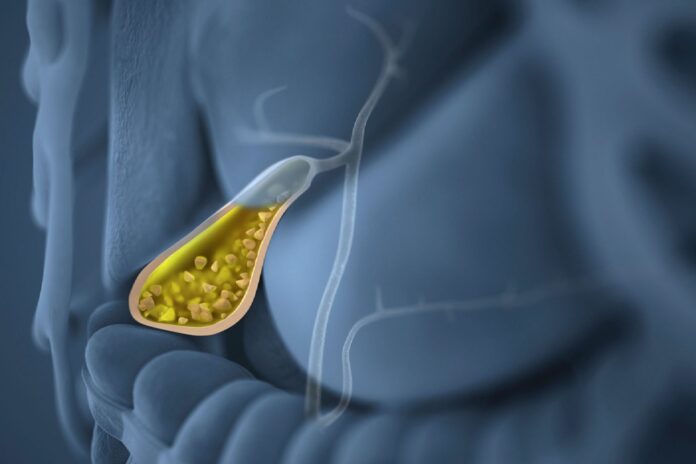 Μάθετε τι είναι οι πολύποδες στη χοληδόχο κύστη, πώς εντοπίζονται, πότε απαιτούν αφαίρεση και ποια είναι η ασφαλέστερη μέθοδος.