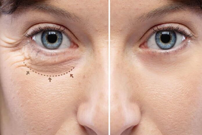 Μάθετε πώς η βλεφαροπλαστική βελτιώνει την εμφάνιση των ματιών και το οπτικό πεδίο, με ασφάλεια και φυσικά αποτελέσματα.