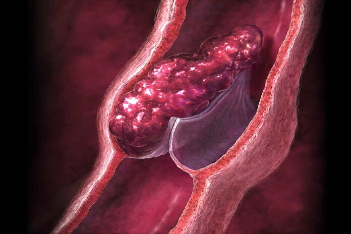 Έως 40% των ενηλίκων εμφανίζουν φλεβικά προβλήματα. Νέες θεραπείες για θρόμβωση και κιρσούς στο 7ο Σχολείο Φλεβολογίας.