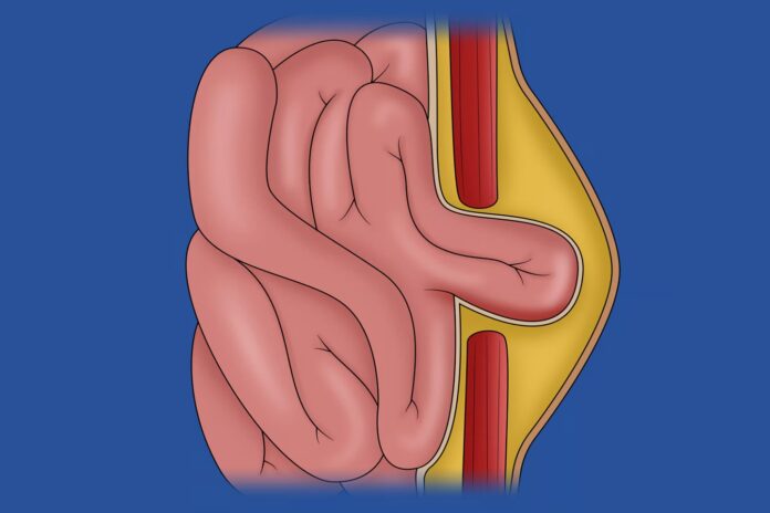 Μάθετε τι είναι η ομφαλοκήλη, ποια είναι τα συμπτώματα, οι παράγοντες κινδύνου και πότε απαιτείται χειρουργική αποκατάσταση.
