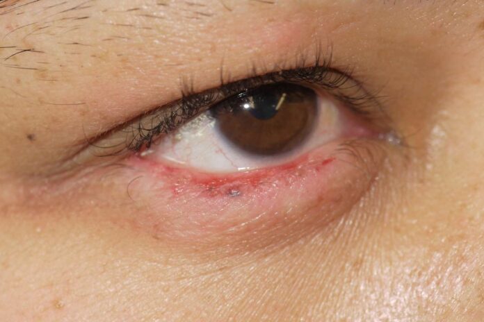 Πώς τα αυτοάνοσα νοσήματα επηρεάζουν τα μάτια; Συμπτώματα, επιπλοκές και πότε πρέπει να απευθυνθείτε σε οφθαλμίατρο.