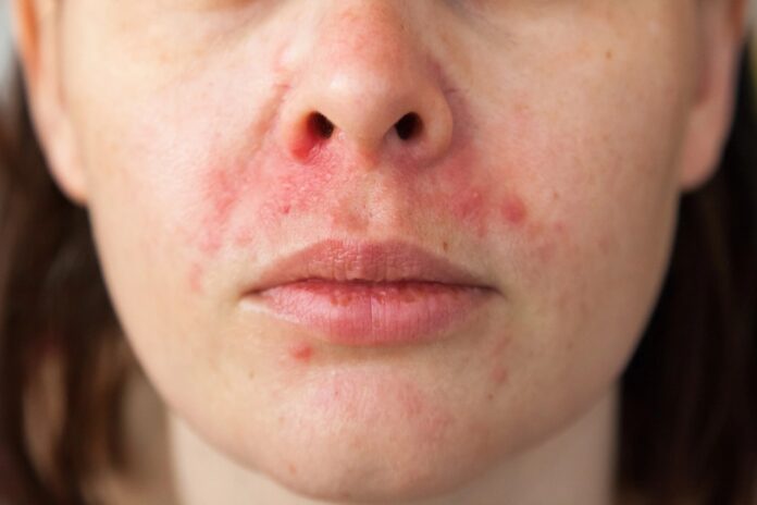 Ακμή γύρω από το στόμα; Δείτε αίτια, συμπτώματα και τρόπους πρόληψης και αντιμετώπισης της περιστοματικής ακμής.