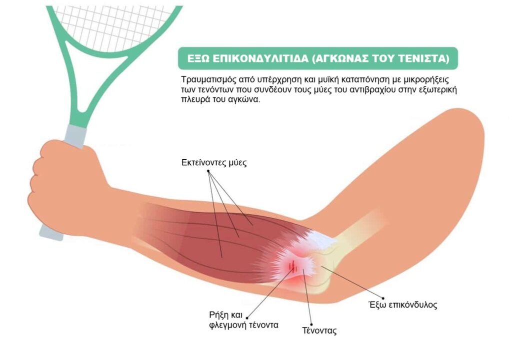 Πόνος στον αγκώνα από χρήση υπολογιστή; Δείτε αίτια, συμπτώματα, πρόληψη και αποτελεσματικές λύσεις αντιμετώπισης.