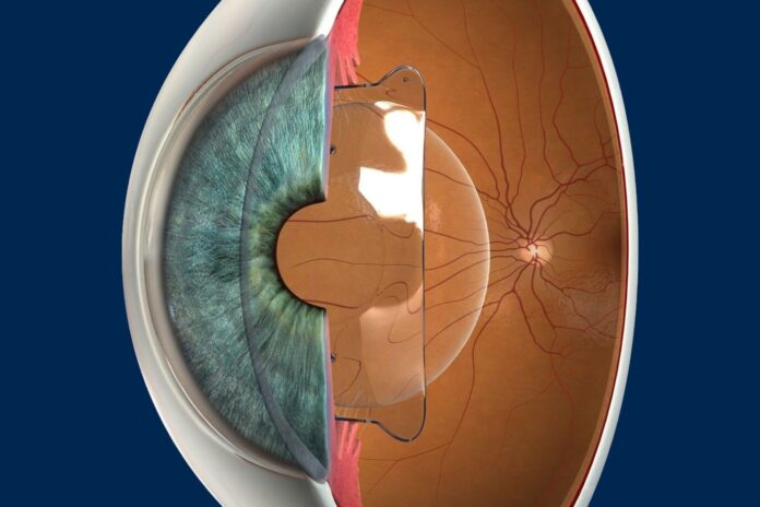 Μυωπία και διαθλαστικά προβλήματα; Δείτε σύγχρονες λύσεις με ICL ενδοφακούς για ασφαλή και αποτελεσματική διόρθωση όρασης.
