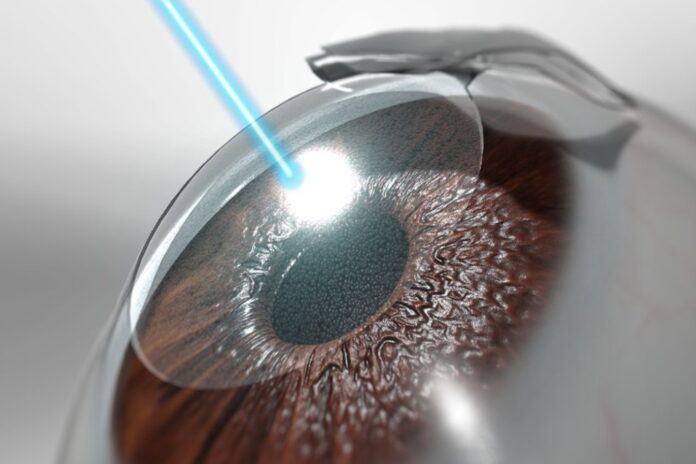 Laser μυωπίας μετά τα 40: τι ισχύει όταν εμφανίζεται πρεσβυωπία, ποιες είναι οι επιλογές και ποιοι είναι κατάλληλοι υποψήφιοι.