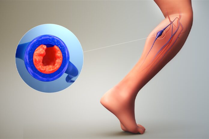 Το έργο ThrombUS+ αναπτύσσει φορετή συσκευή με τεχνητή νοημοσύνη για την έγκαιρη ανίχνευση της εν τω βάθει φλεβικής θρόμβωσης.